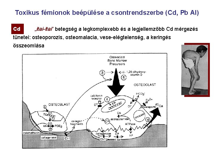 Toxikus fémionok beépülése a csontrendszerbe (Cd, Cd Pb Al) Cd „itai-itai” betegség a legkomplexebb