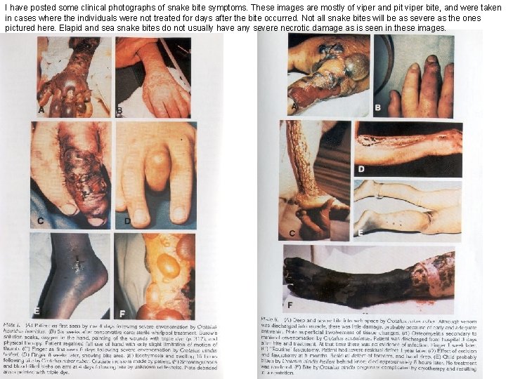 I have posted some clinical photographs of snake bite symptoms. These images are mostly