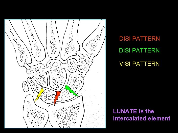 DISI PATTERN VISI PATTERN LUNATE is the intercalated element 