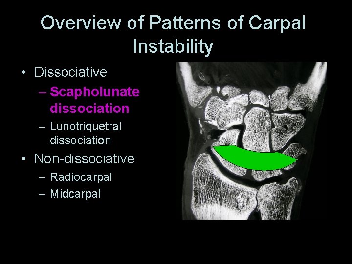 Overview of Patterns of Carpal Instability • Dissociative – Scapholunate dissociation – Lunotriquetral dissociation