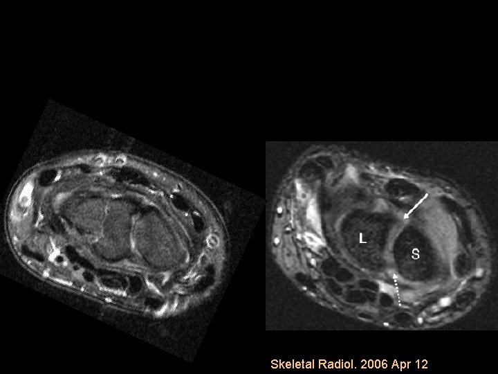Skeletal Radiol. 2006 Apr 12 