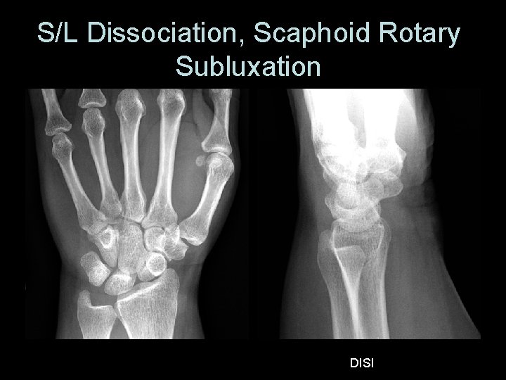 S/L Dissociation, Scaphoid Rotary Subluxation DISI 