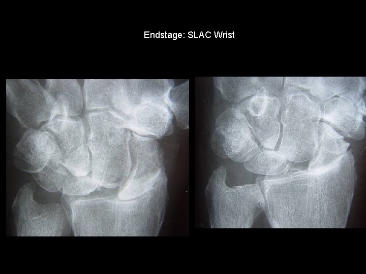 Endstage: SLAC Wrist 