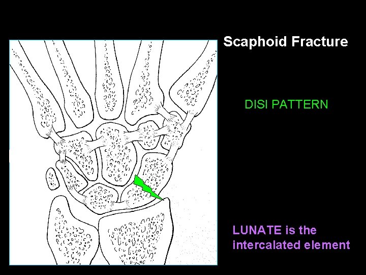 Scaphoid Fracture DISI PATTERN LUNATE is the intercalated element 