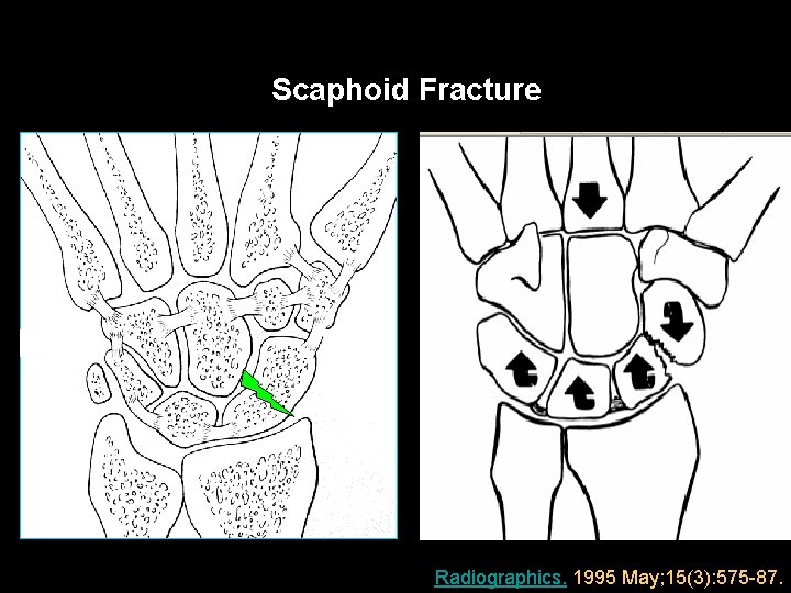 Scaphoid Fracture DISI PATTERN LUNATE is the intercalated element Radiographics. 1995 May; 15(3): 575