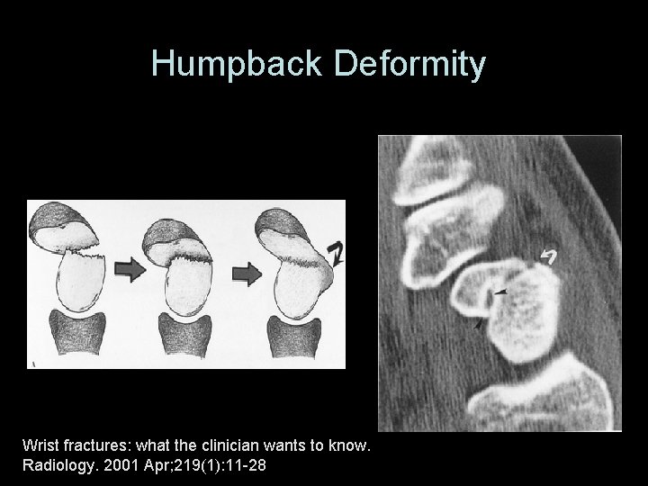 Humpback Deformity Wrist fractures: what the clinician wants to know. Radiology. 2001 Apr; 219(1):