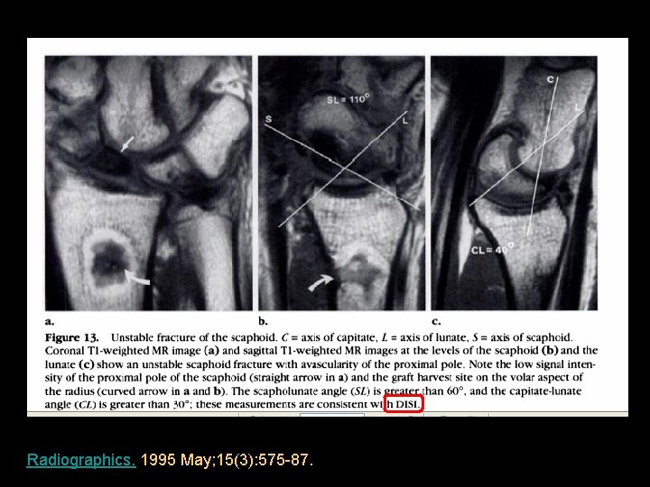 Radiographics. 1995 May; 15(3): 575 -87. 