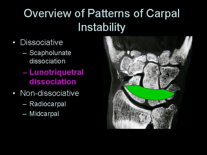Overview of Patterns of Carpal Instability • Dissociative – Scapholunate dissociation – Lunotriquetral dissociation