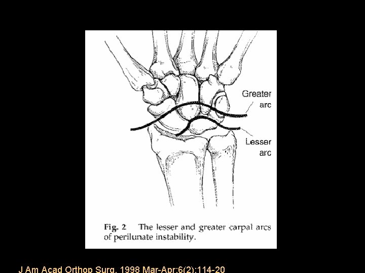 J Am Acad Orthop Surg. 1998 Mar-Apr; 6(2): 114 -20 