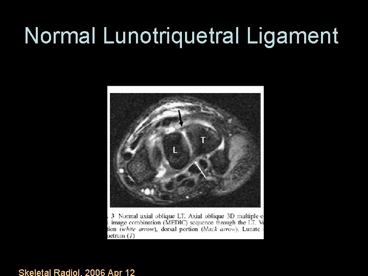 Normal Lunotriquetral Ligament Skeletal Radiol. 2006 Apr 12 