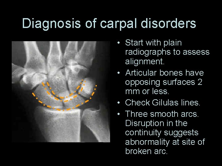 Diagnosis of carpal disorders • Start with plain radiographs to assess alignment. • Articular