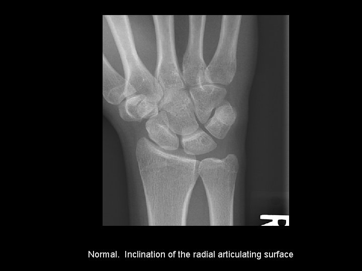 Normal. Inclination of the radial articulating surface 