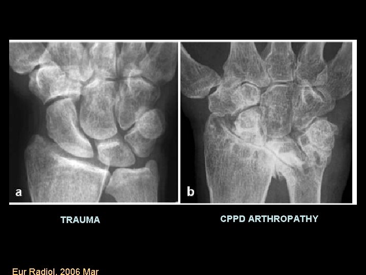 TRAUMA Eur Radiol. 2006 Mar CPPD ARTHROPATHY 