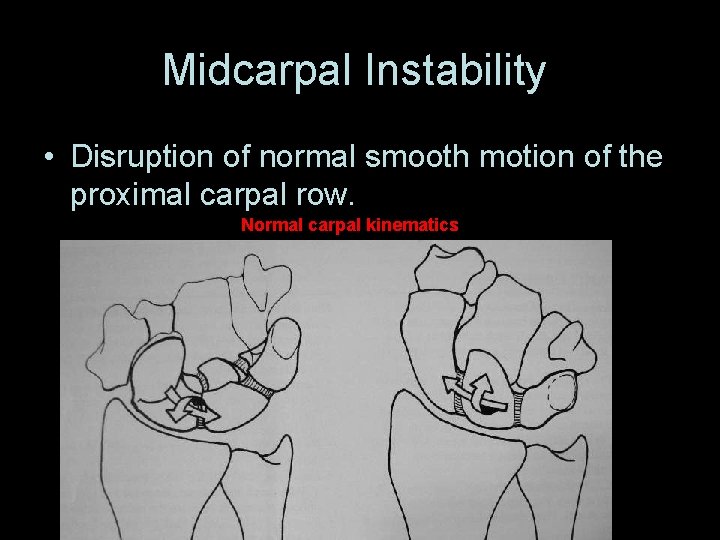 Midcarpal Instability • Disruption of normal smooth motion of the proximal carpal row. Normal