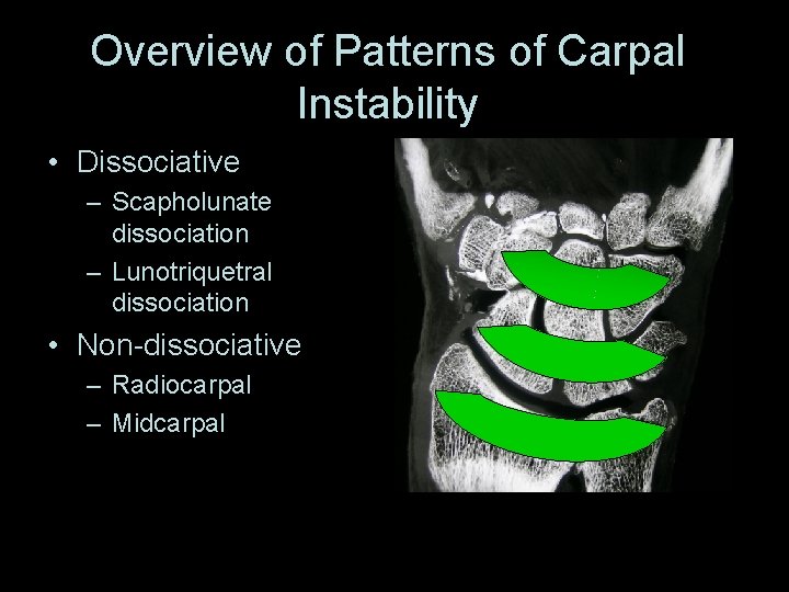 Overview of Patterns of Carpal Instability • Dissociative – Scapholunate dissociation – Lunotriquetral dissociation