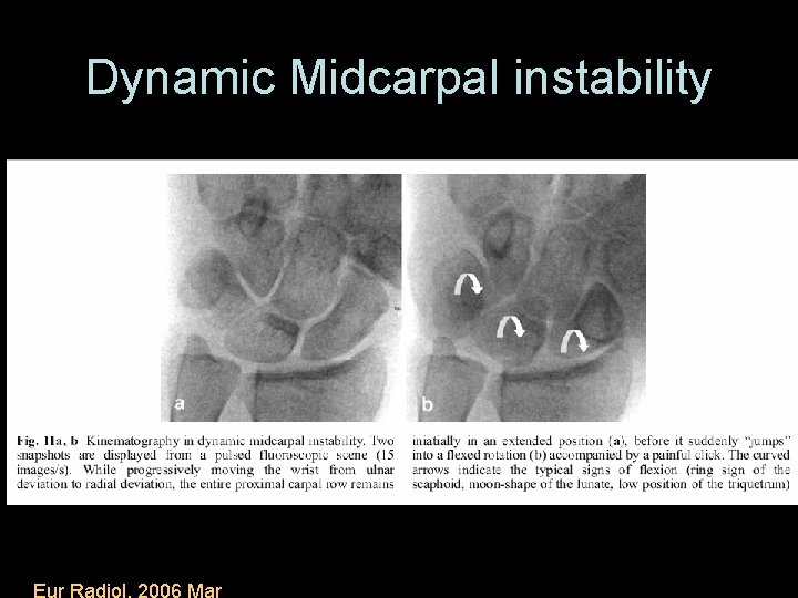 Dynamic Midcarpal instability Eur Radiol. 2006 Mar 