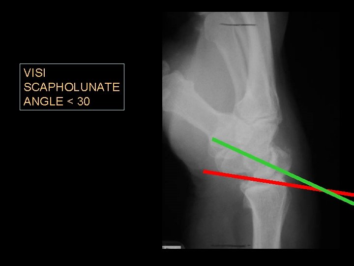VISI SCAPHOLUNATE ANGLE < 30 