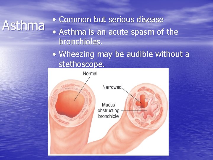 Asthma • Common but serious disease • Asthma is an acute spasm of the