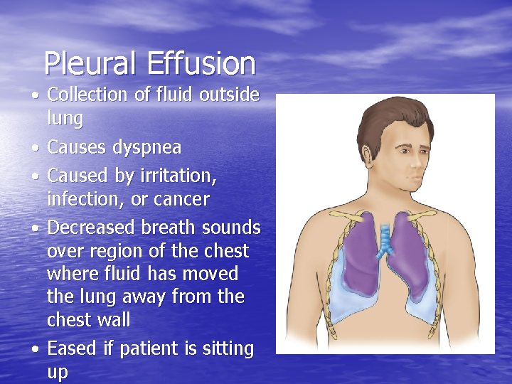 Pleural Effusion • Collection of fluid outside lung • Causes dyspnea • Caused by