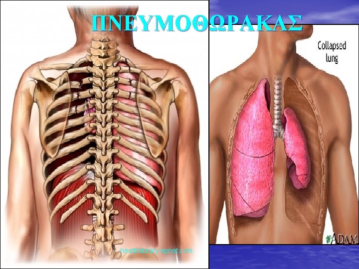 ΠΝΕΥΜΟΘΩΡΑΚΑΣ healthlibrary. epnet. com 