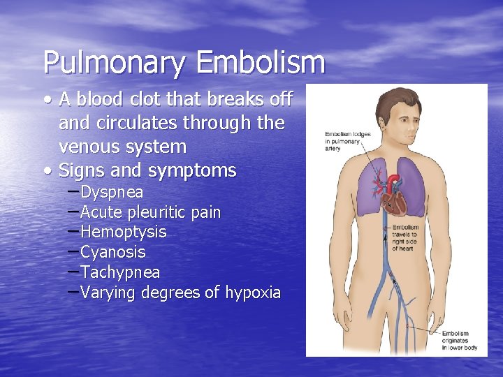 Pulmonary Embolism • A blood clot that breaks off and circulates through the venous