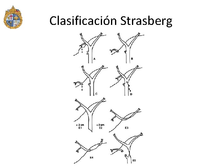 Clasificación Strasberg 