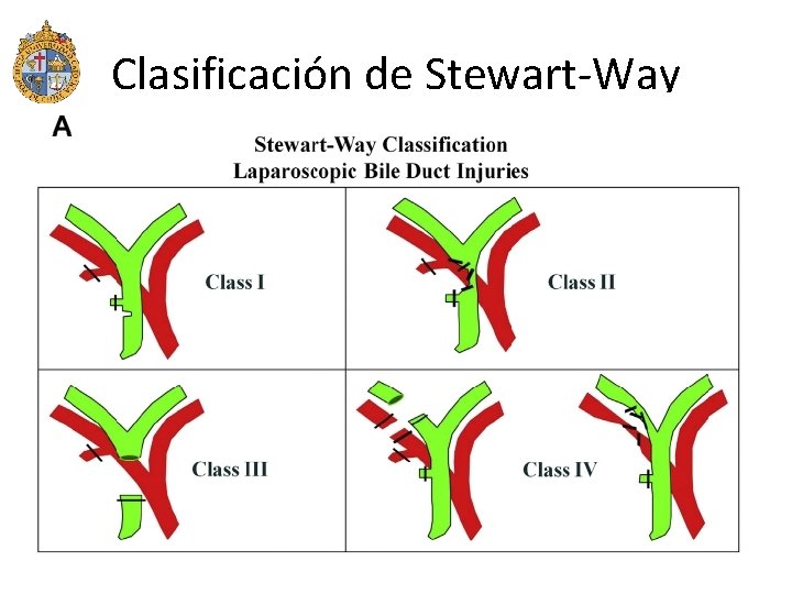 Clasificación de Stewart-Way 