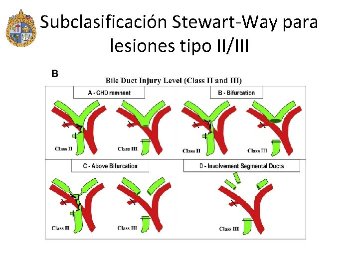 Subclasificación Stewart-Way para lesiones tipo II/III 