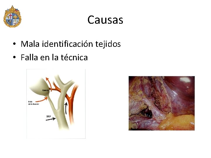 Causas • Mala identificación tejidos • Falla en la técnica 