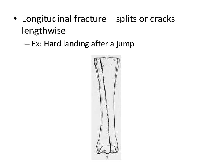  • Longitudinal fracture – splits or cracks lengthwise – Ex: Hard landing after