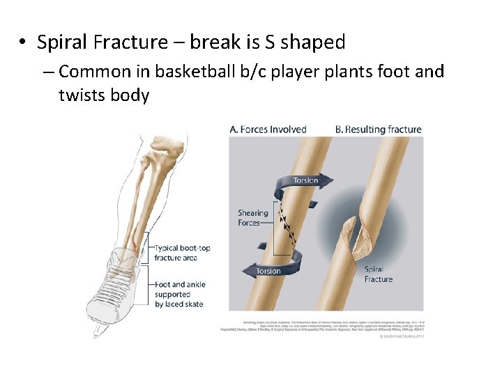  • Spiral Fracture – break is S shaped – Common in basketball b/c