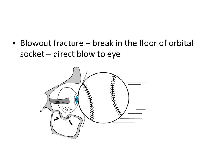  • Blowout fracture – break in the floor of orbital socket – direct