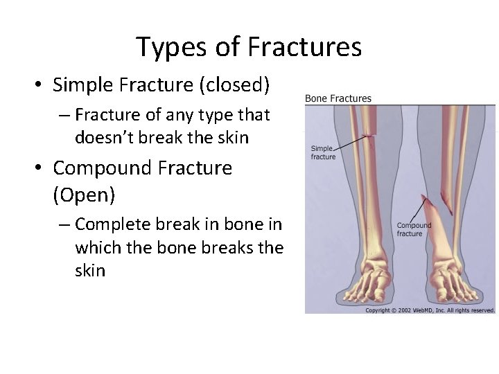 Bone Injuries Fractures a partial or complete break