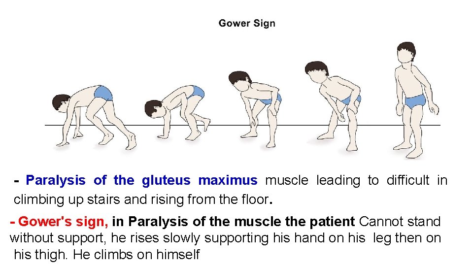 - Paralysis of the gluteus maximus muscle leading to difficult in climbing up stairs