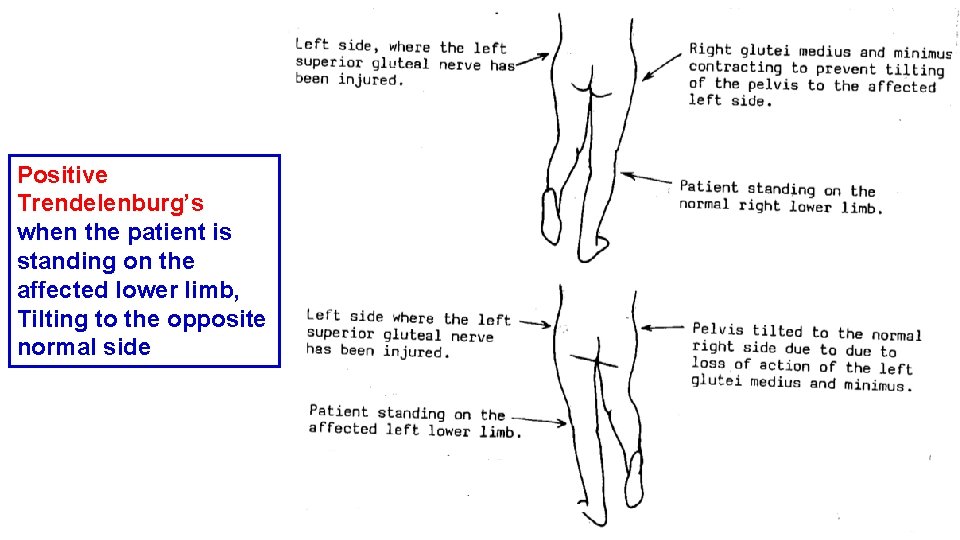 Positive Trendelenburg’s when the patient is standing on the affected lower limb, Tilting to