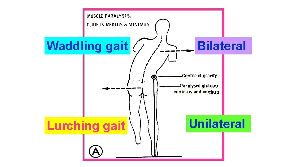 Waddling gait Bilateral Lurching gait Unilateral 