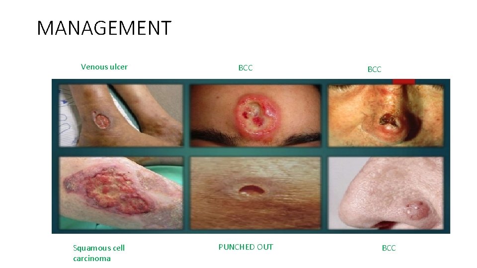 MANAGEMENT Venous ulcer Squamous cell carcinoma BCC PUNCHED OUT BCC 