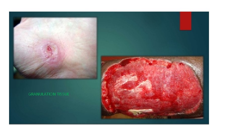 GRANULATION TISSUE 