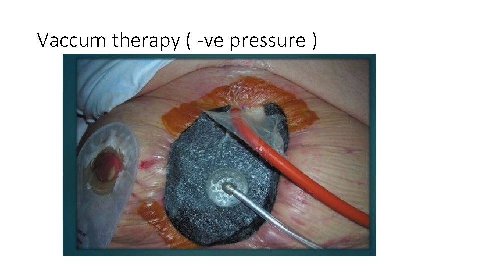 Vaccum therapy ( -ve pressure ) 