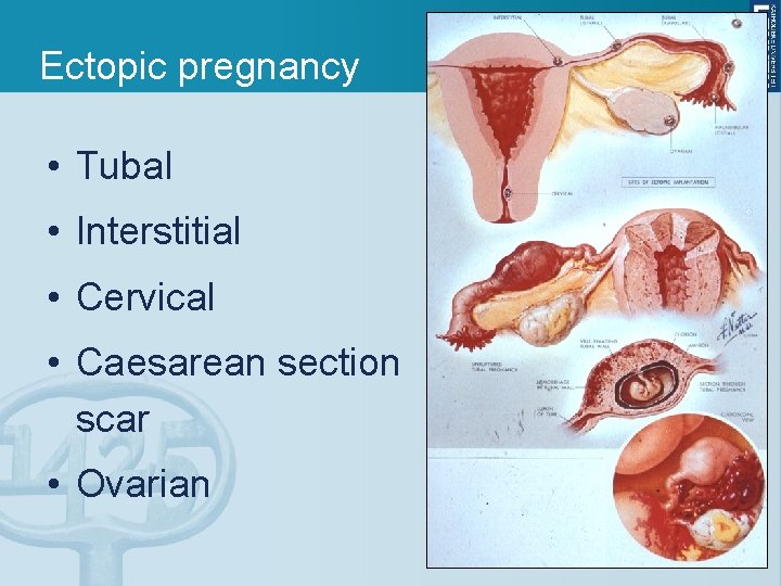 Ectopic pregnancy • Tubal • Interstitial • Cervical • Caesarean section scar • Ovarian