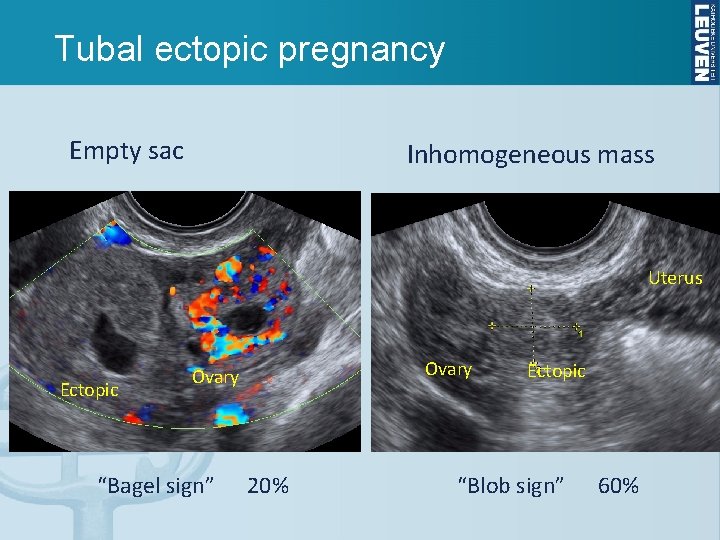 Tubal ectopic pregnancy Empty sac Inhomogeneous mass Uterus Ectopic Ovary “Bagel sign” 20% Ectopic