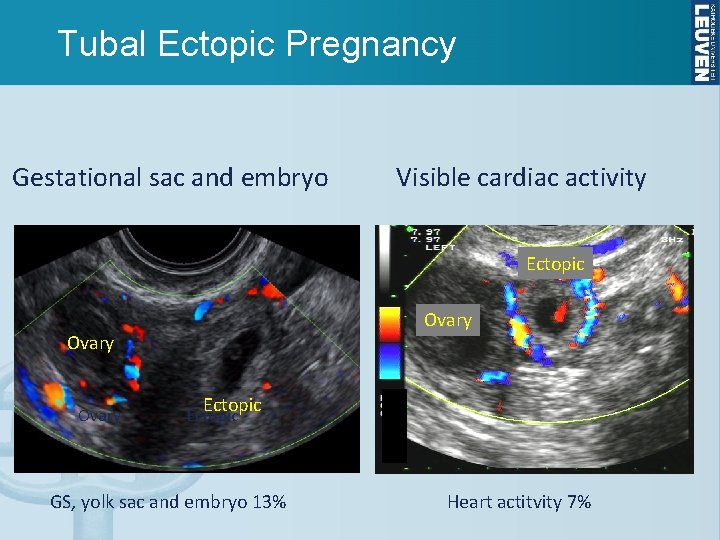 Tubal Ectopic Pregnancy Gestational sac and embryo Visible cardiac activity Ectopic Ovary Ectopic GS,