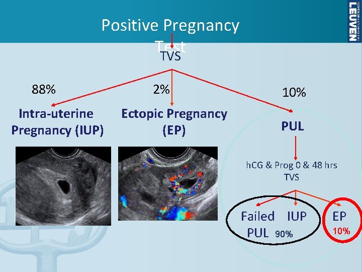 Positive Pregnancy Test TVS 88% Intra-uterine Pregnancy (IUP) 2% Ectopic Pregnancy (EP) 10% PUL