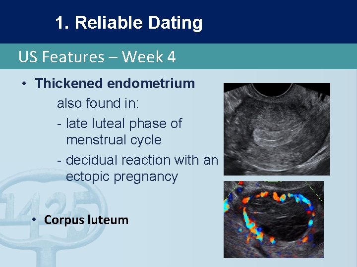 1. Reliable Dating US Features – Week 4 • Thickened endometrium also found in: