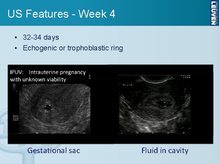 US Features - Week 4 • 32 -34 days • Echogenic or trophoblastic ring