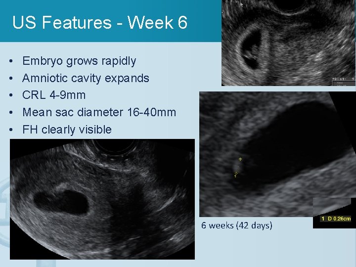 US Features - Week 6 • • • Embryo grows rapidly Amniotic cavity expands