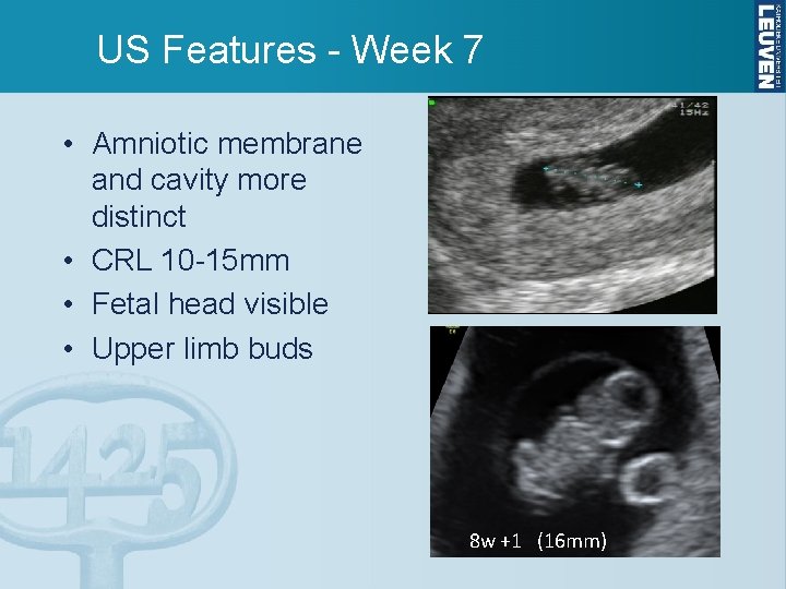 US Features - Week 7 • Amniotic membrane and cavity more distinct • CRL