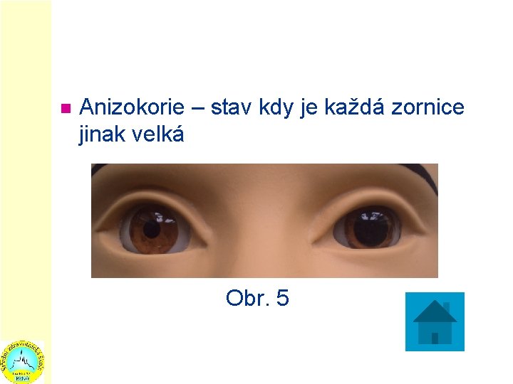 n Anizokorie – stav kdy je každá zornice jinak velká Obr. 5 