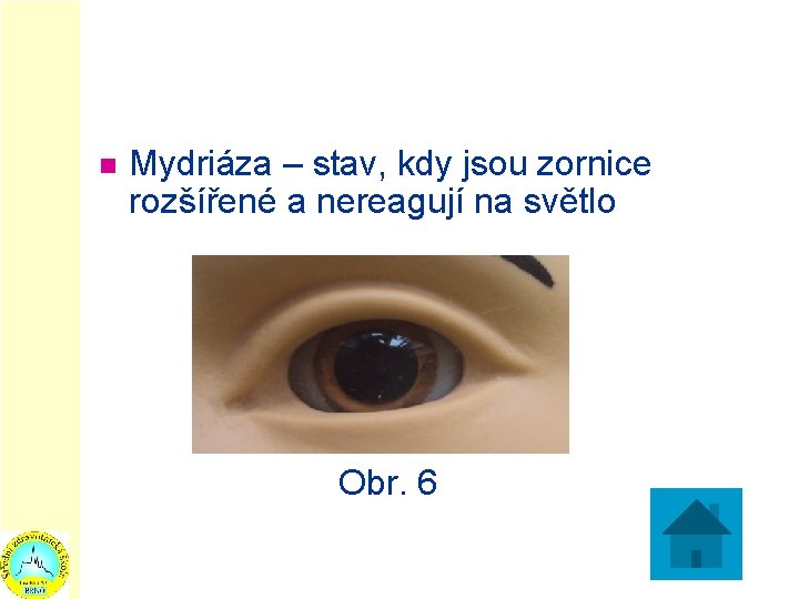 n Mydriáza – stav, kdy jsou zornice rozšířené a nereagují na světlo Obr. 6