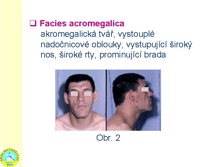 q Facies acromegalica akromegalická tvář, vystouplé nadočnicové oblouky, vystupující široký nos, široké rty, prominující